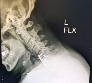 Name:  Neck X-Ray, L-Flex, Jun 2022 - cropped.jpg
Views: 9132
Size:  30.2 KB